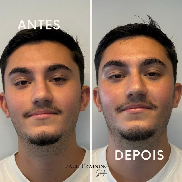 🌟Limpeza de pele em Lisboa! 🌟
Nada como uma limpeza de pele profunda para renovar, hidratar e revitalizar a tua pele. 💆♂️💆♀️
O nosso tratamento inclui:
✨ Massagens faciais relaxantes
✨ Cremes específicos para cada tipo de pele
✨ Ferramentas profissionais para uma limpeza profunda e efeito lifting natural
O resultado? Uma pele mais luminosa, firme e saudável, perfeita para mostrar a tua melhor versão. 😍
Se queres uma pele incrível, podes fazer a tua reserva connosco ou presencialmente. Não percas a oportunidade de cuidar de ti! 💻✨
#limpezadepele #esteticafacial #cuidadoscomapele #estetica #peleoleosa #acne #peleperfeita #limpezadepeleprofunda #lisboa #portugal #beleza #skincare #antesedepois #transformacaodepele #massagemfacial #foryou #paravoce