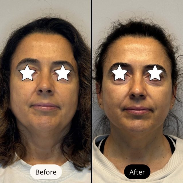 Flacidez: um dos sinais que mais incomodam com o passar da idade
Com o avanço da idade, o corpo reduz naturalmente a produção de colagénio e elastina — duas proteínas essenciais para manter a pele firme, tonificada e jovem.
O resultado? Flacidez, perda de definição e um aspeto cansado da pele.
Áreas como rosto, pescoço, contorno mandibular, abdómen e braços são das mais afetadas.
Depois de 6 sessões de Radiofrequência
✔️ Pele visivelmente mais firme e tonificada
✔️ Estimulação profunda de colagénio
✔️ Melhoria da textura e elasticidade
✔️ Contornos mais definidos e rejuvenescidos
Como atua a Radiofrequência?
A radiofrequência aquece as camadas profundas da pele de forma controlada, estimulando a produção natural de colagénio, promovendo um efeito tensor progressivo e seguro.
✨ Tratamento não invasivo, indolor e com resultados cumulativos.
Agende a sua avaliação e descobra o protocolo ideal para si.
⸻
#Flacidez #Radiofrequência #AntesEDepois #Colagénio #rejuvenescimentodopescoço